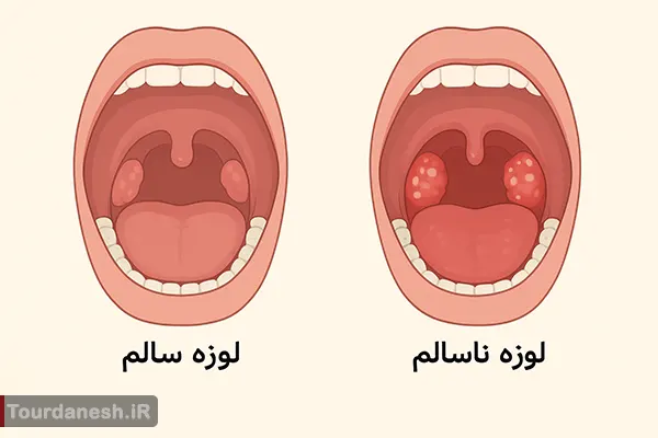عکس لوزه سالم و ناسالم